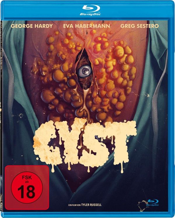 Cyst
